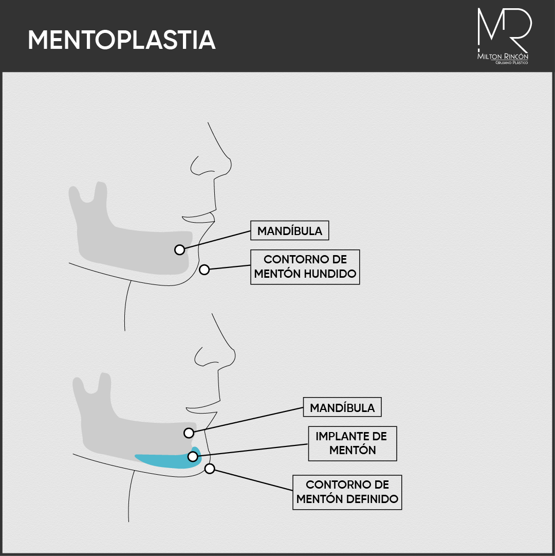 Evolución de abdominoplastia